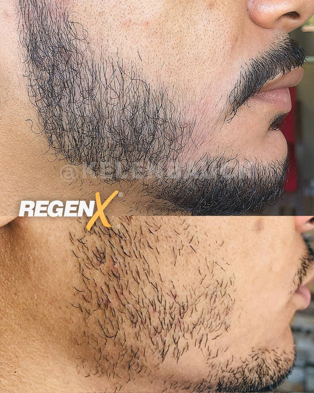 RegenX