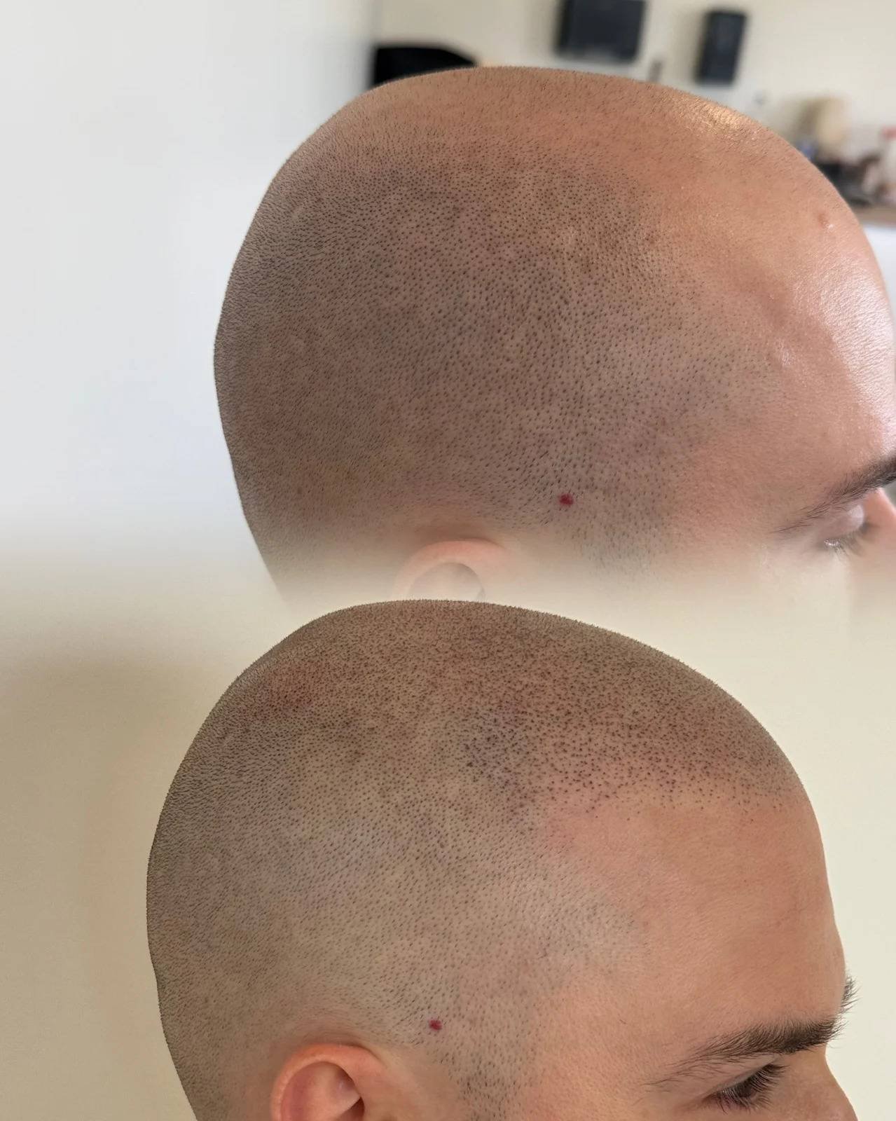 trichopigmentation